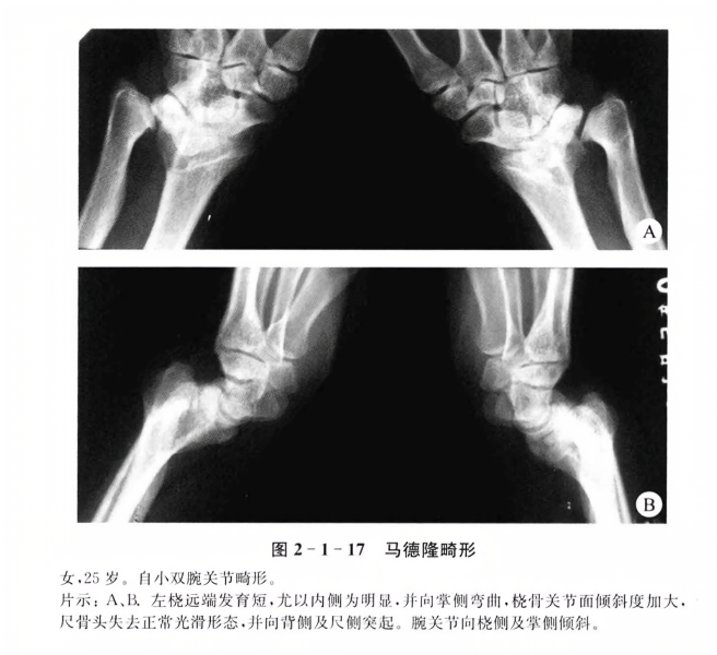 马德隆畸形最新治疗指南